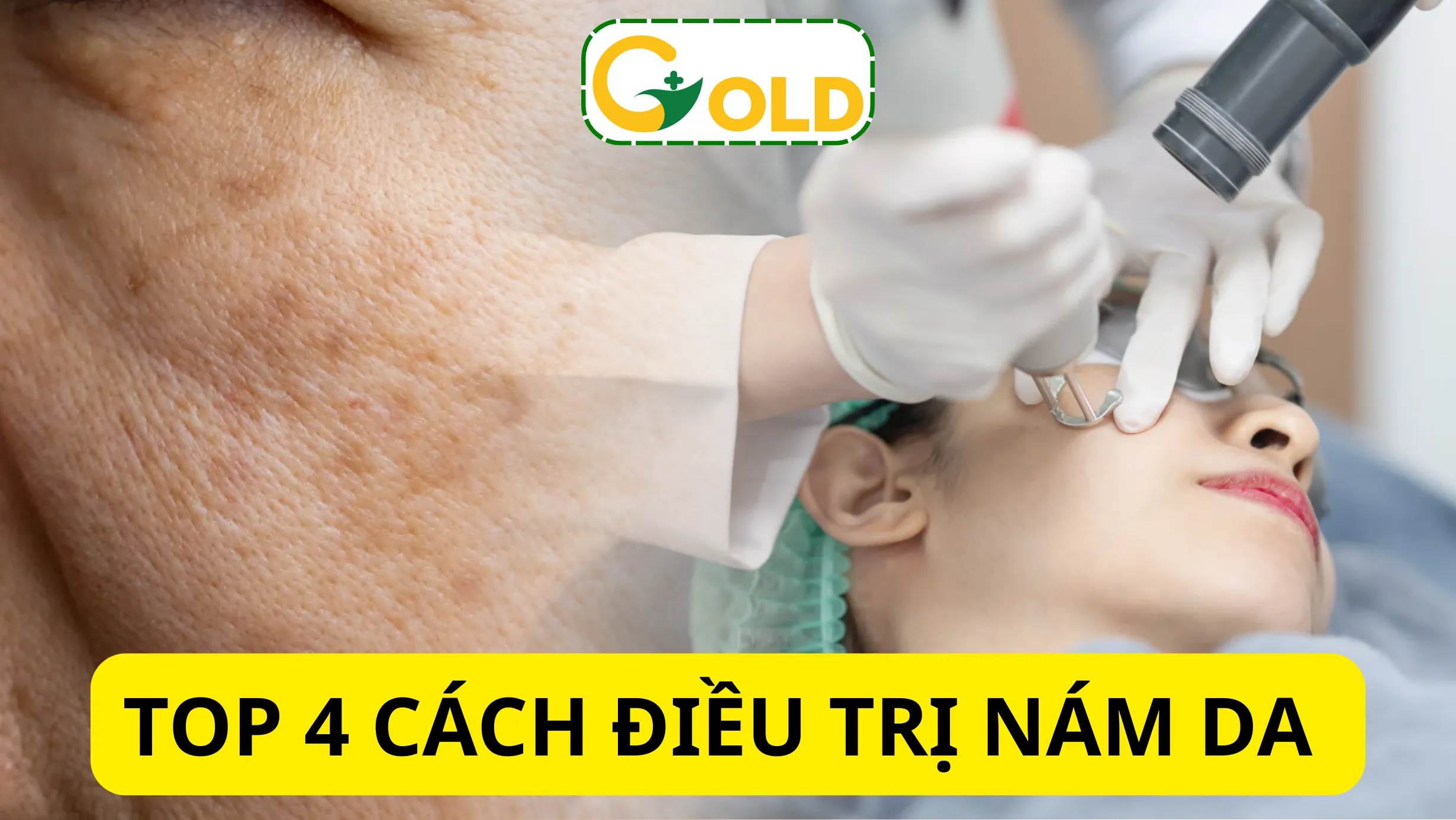 Bệnh nám da mặt và cách Bệnh nám da mặt và cách điều trị